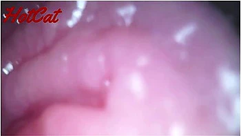 Endoscopic Vaginal Observation
